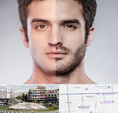 کاشت ریش و سبیل در مرکز تهران