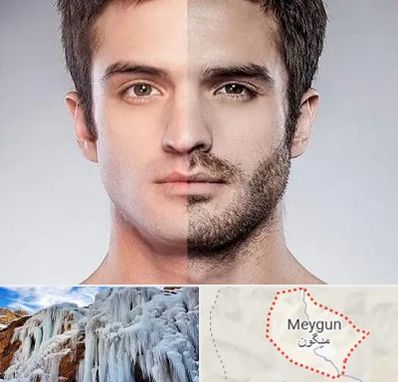 کاشت ریش و سبیل در میگون