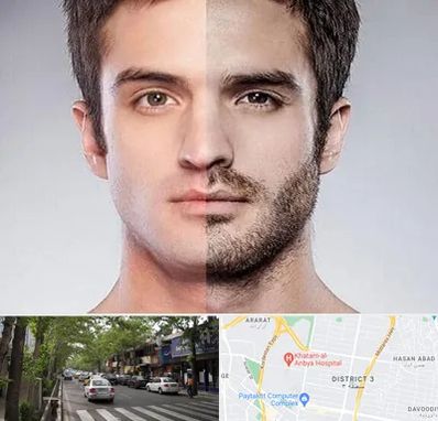 کاشت ریش و سبیل در ظفر