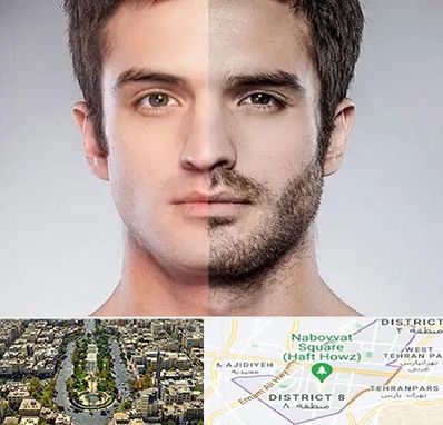 کاشت ریش و سبیل در نارمک