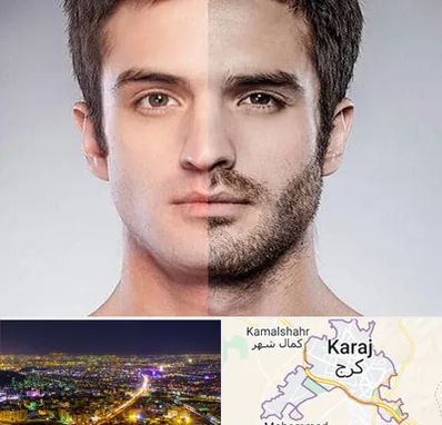 کاشت ریش و سبیل در کرج