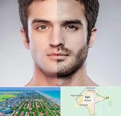 کاشت ریش و سبیل در ساری