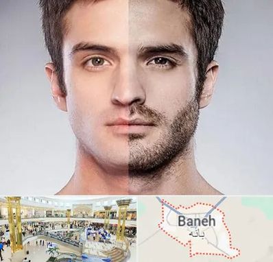 کاشت ریش و سبیل در بانه