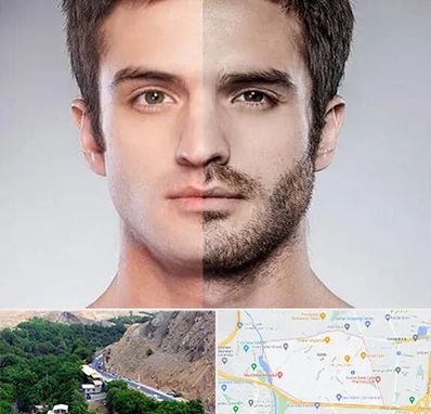 کاشت ریش و سبیل در کن