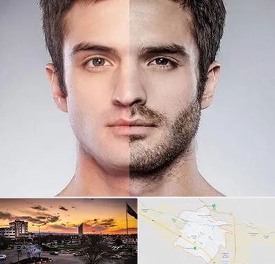 کاشت ریش و سبیل در قوچان