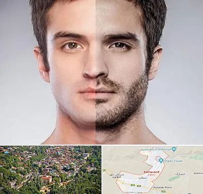 کاشت ریش و سبیل در دماوند