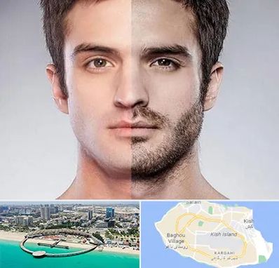 کاشت ریش و سبیل در کیش