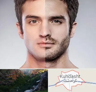 کاشت ریش و سبیل در کوهدشت