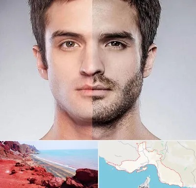 کاشت ریش و سبیل در هرمزگان