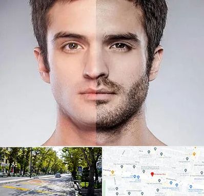 کاشت ریش و سبیل در میرداماد