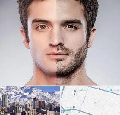 کاشت ریش و سبیل در ازگل