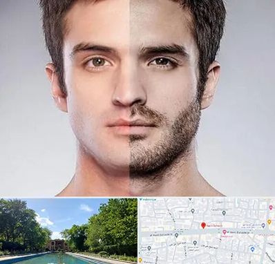 کاشت ریش و سبیل در هشت بهشت اصفهان