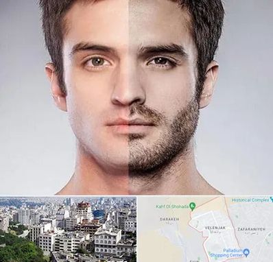 کاشت ریش و سبیل در ولنجک