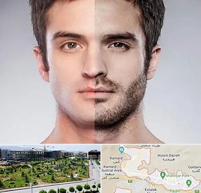 کاشت ریش و سبیل در پردیس