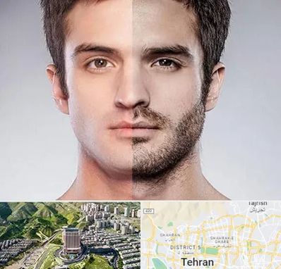 کاشت ریش و سبیل در شمال تهران