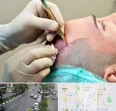 کلینیک کاشت مو در ستارخان