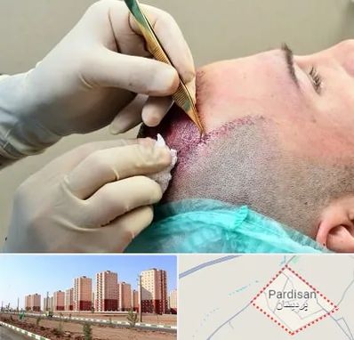 کلینیک کاشت مو در پردیسان قم
