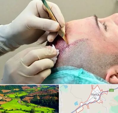 کلینیک کاشت مو در نکا