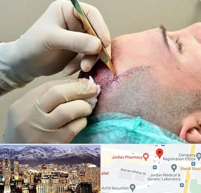 کلینیک کاشت مو در جردن