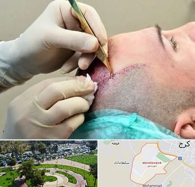 کلینیک کاشت مو در مهرشهر کرج