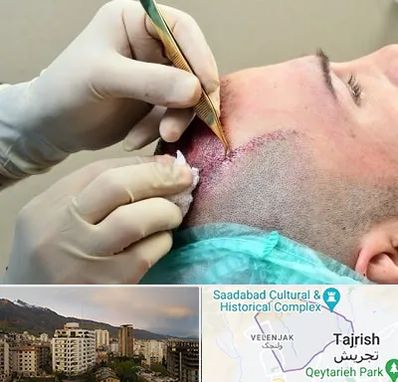 کلینیک کاشت مو در زعفرانیه