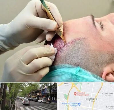 کلینیک کاشت مو در ظفر