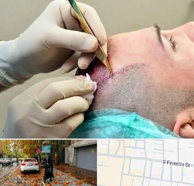 کلینیک کاشت مو در خیابان فلسطین