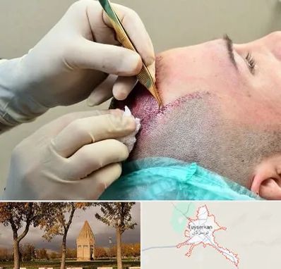 کلینیک کاشت مو در تویسرکان