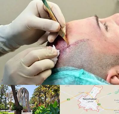 کلینیک کاشت مو در نیشابور