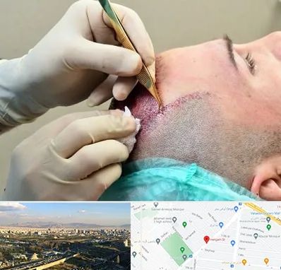 کلینیک کاشت مو در هنگام