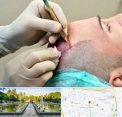 کلینیک کاشت مو در سرسبز