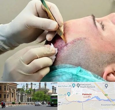 کلینیک کاشت مو در پاکدشت