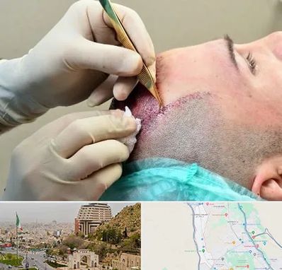 کلینیک کاشت مو در فرهنگ شهر شیراز