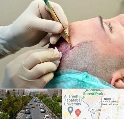 کلینیک کاشت مو در شهران