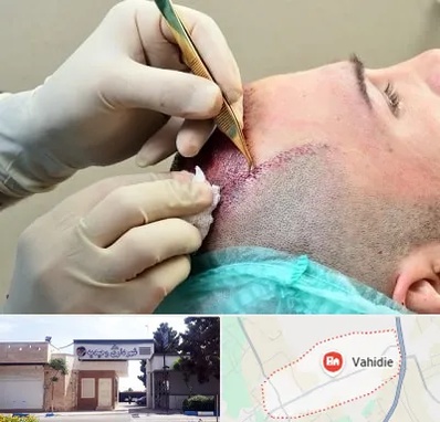 کلینیک کاشت مو در وحیدیه شهریار