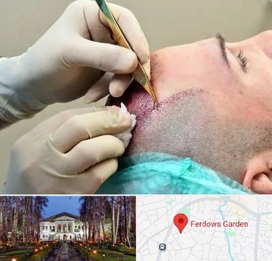 کلینیک کاشت مو در باغ فردوس