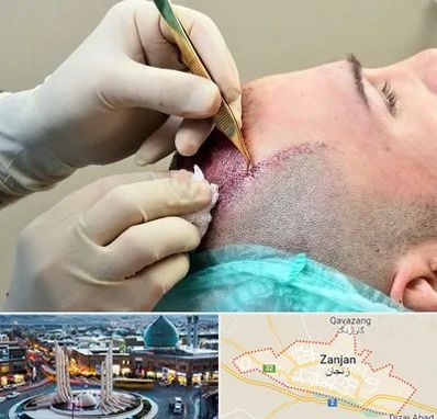 کلینیک کاشت مو در زنجان