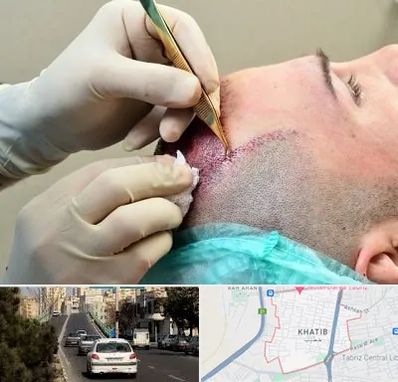 کلینیک کاشت مو در خطیب تبریز