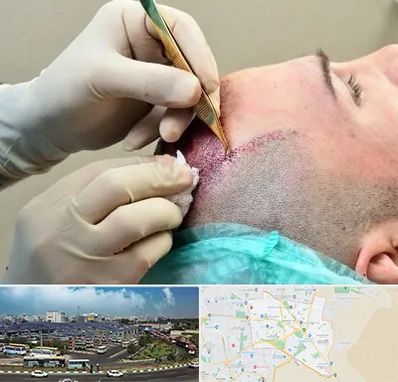 کلینیک کاشت مو در منطقه 15 تهران