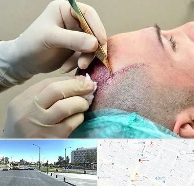 کلینیک کاشت مو در بلوار کلاهدوز مشهد