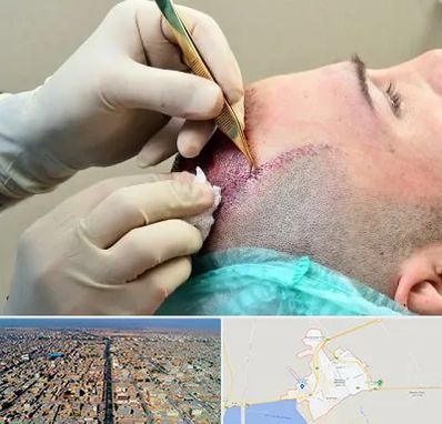 کلینیک کاشت مو در بندر ماهشهر