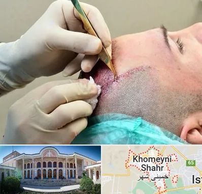 کلینیک کاشت مو در خمینی شهر