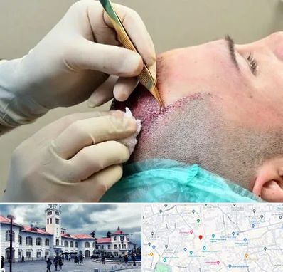 کلینیک کاشت مو در میدان شهرداری رشت