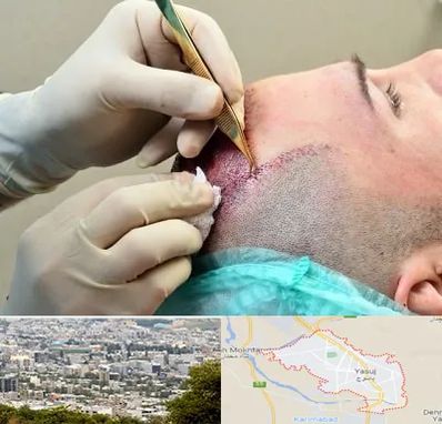 کلینیک کاشت مو در یاسوج