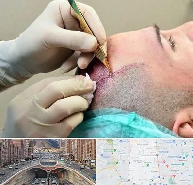کلینیک کاشت مو در منطقه 10 تهران
