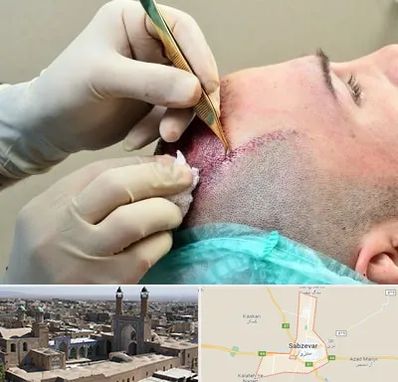 کلینیک کاشت مو در سبزوار