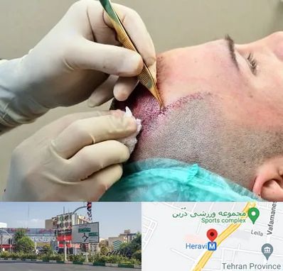 کلینیک کاشت مو در هروی