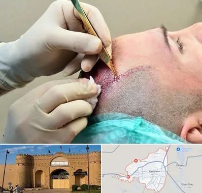 کلینیک کاشت مو در ایرانشهر