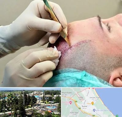 کلینیک کاشت مو در رودسر