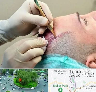کلینیک کاشت مو در تجریش